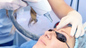 llézeres tetoválás eltávolítás